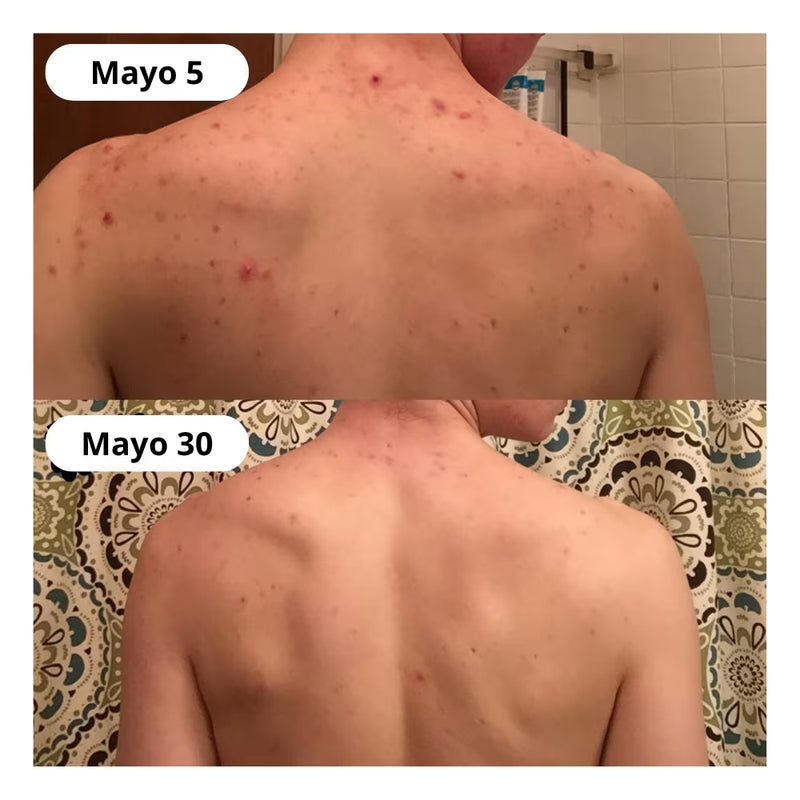 Dile adiós al acné corporal en 30 días